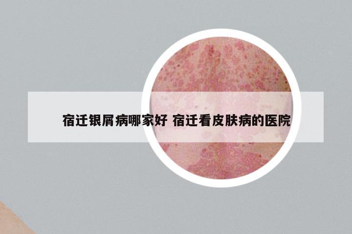宿迁银屑病哪家好 宿迁看皮肤病的医院