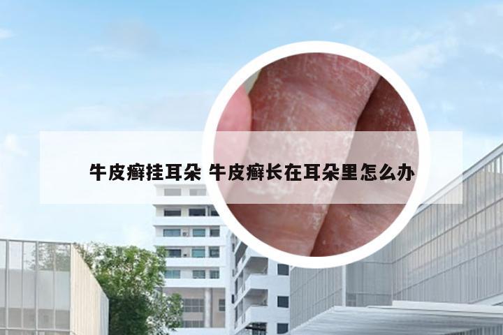 牛皮癣挂耳朵 牛皮癣长在耳朵里怎么办