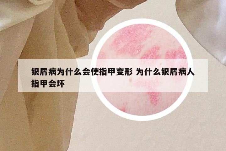 银屑病为什么会使指甲变形 为什么银屑病人指甲会坏
