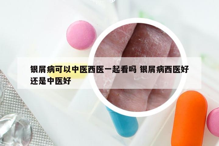 银屑病可以中医西医一起看吗 银屑病西医好还是中医好