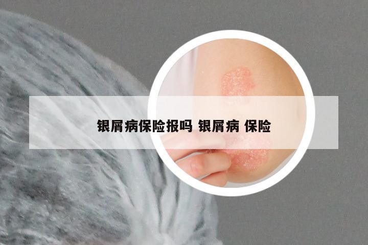银屑病保险报吗 银屑病 保险