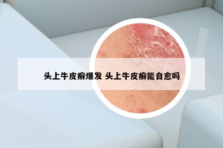 头上牛皮癣爆发 头上牛皮癣能自愈吗