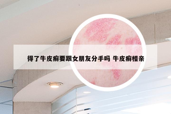 得了牛皮癣要跟女朋友分手吗 牛皮癣相亲