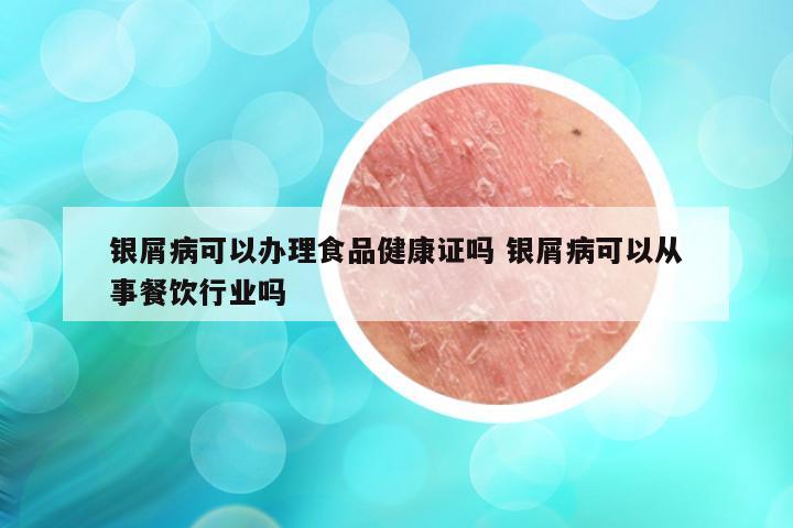 银屑病可以办理食品健康证吗 银屑病可以从事餐饮行业吗