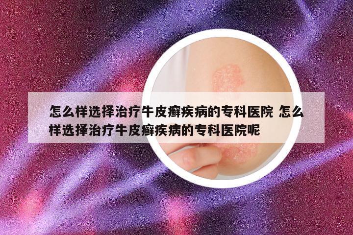 怎么样选择治疗牛皮癣疾病的专科医院 怎么样选择治疗牛皮癣疾病的专科医院呢