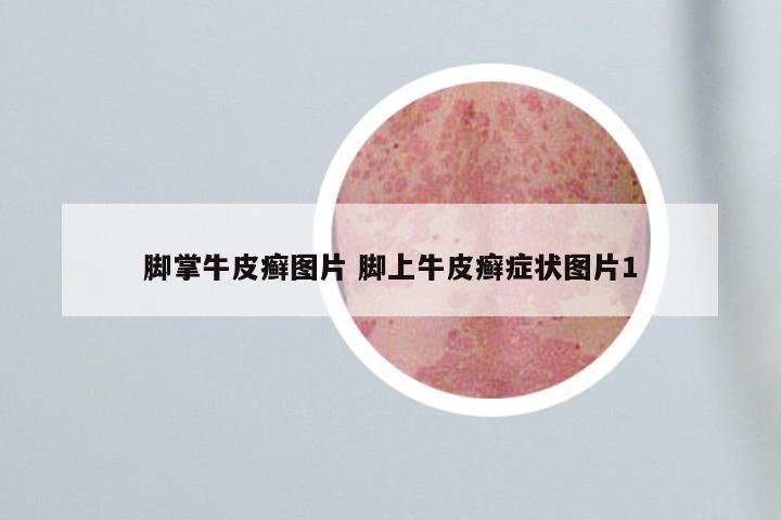 脚掌牛皮癣图片 脚上牛皮癣症状图片1