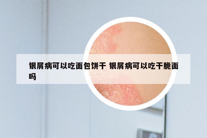 银屑病可以吃面包饼干 银屑病可以吃干脆面吗