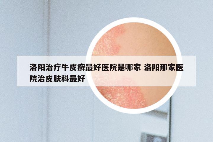 洛阳治疗牛皮癣最好医院是哪家 洛阳那家医院治皮肤科最好