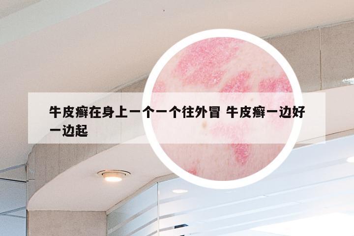 牛皮癣在身上一个一个往外冒 牛皮癣一边好一边起