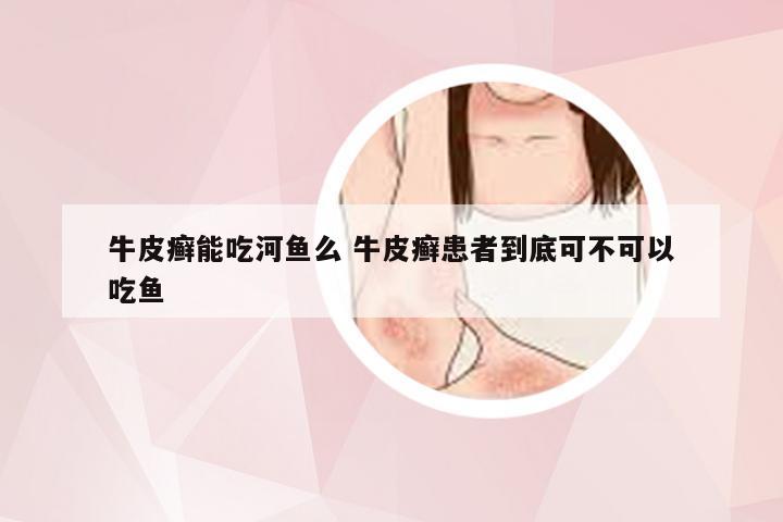 牛皮癣能吃河鱼么 牛皮癣患者到底可不可以吃鱼