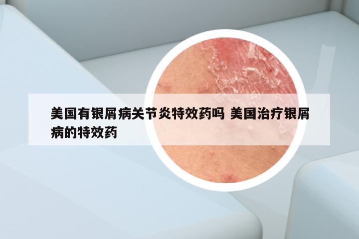 美国有银屑病关节炎特效药吗 美国治疗银屑病的特效药