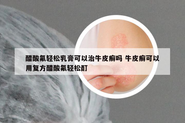 醋酸氟轻松乳膏可以治牛皮癣吗 牛皮癣可以用复方醋酸氟轻松酊