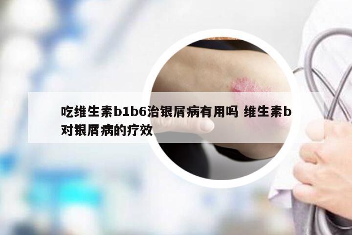吃维生素b1b6治银屑病有用吗 维生素b对银屑病的疗效