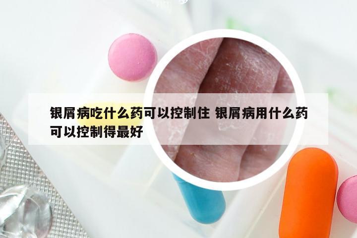 银屑病吃什么药可以控制住 银屑病用什么药可以控制得最好