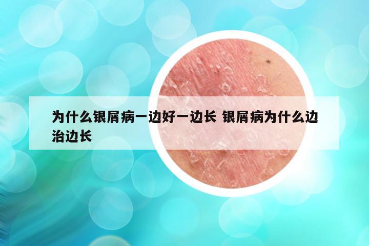为什么银屑病一边好一边长 银屑病为什么边治边长