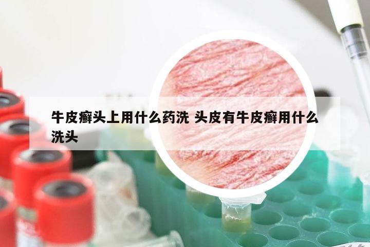 牛皮癣头上用什么药洗 头皮有牛皮癣用什么洗头