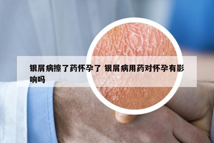 银屑病擦了药怀孕了 银屑病用药对怀孕有影响吗
