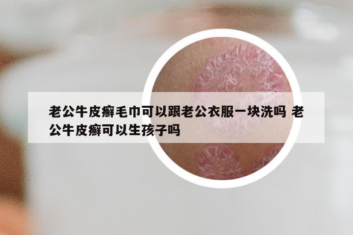 老公牛皮癣毛巾可以跟老公衣服一块洗吗 老公牛皮癣可以生孩子吗