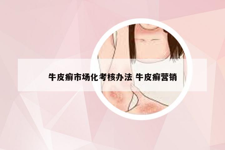 牛皮癣市场化考核办法 牛皮癣营销