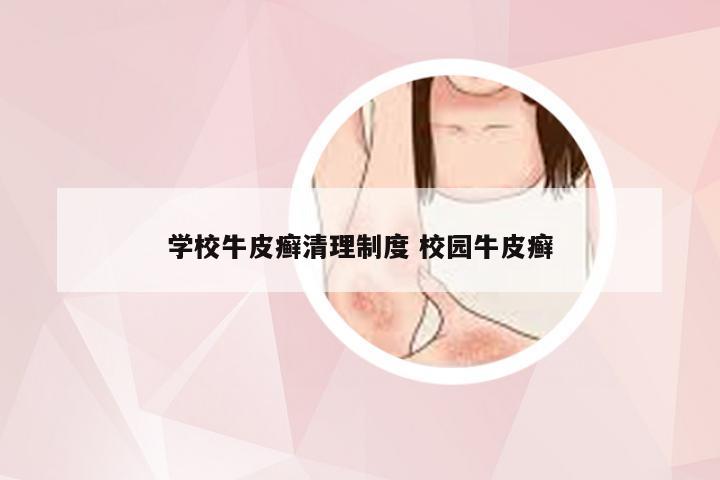 学校牛皮癣清理制度 校园牛皮癣