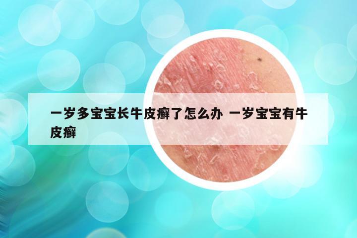 一岁多宝宝长牛皮癣了怎么办 一岁宝宝有牛皮癣