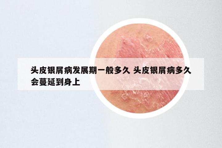 头皮银屑病发展期一般多久 头皮银屑病多久会蔓延到身上