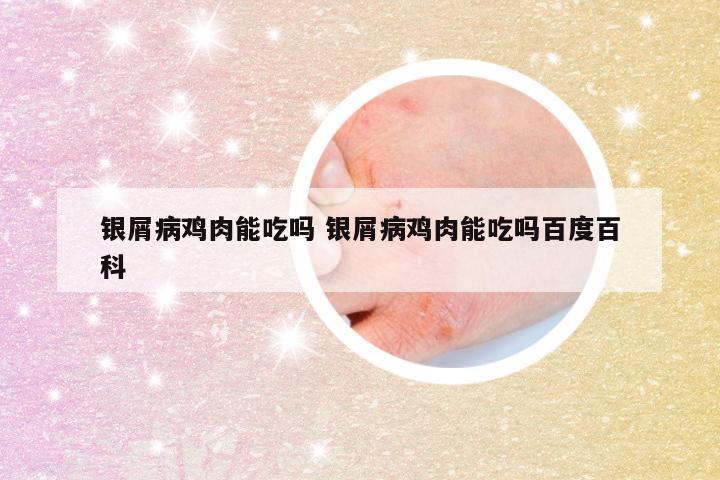 银屑病鸡肉能吃吗 银屑病鸡肉能吃吗百度百科