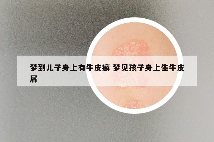 梦到儿子身上有牛皮癣 梦见孩子身上生牛皮屑