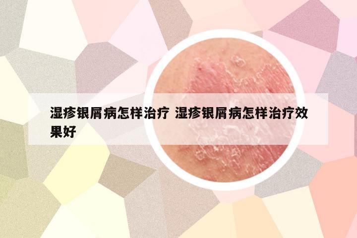 湿疹银屑病怎样治疗 湿疹银屑病怎样治疗效果好