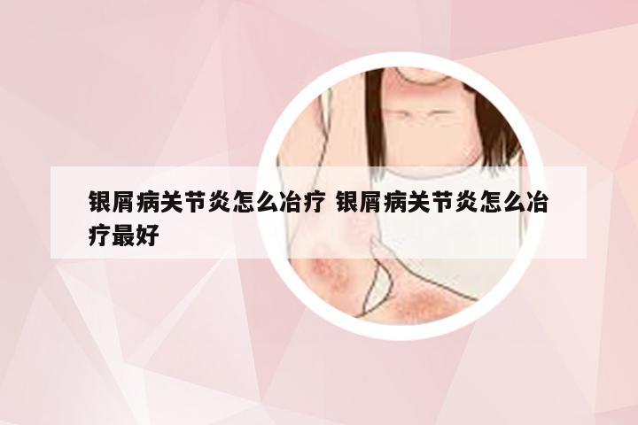 银屑病关节炎怎么冶疗 银屑病关节炎怎么冶疗最好