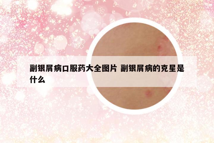 副银屑病口服药大全图片 副银屑病的克星是什么