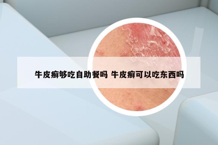 牛皮癣够吃自助餐吗 牛皮癣可以吃东西吗