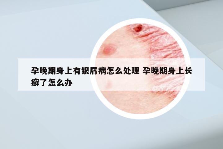 孕晚期身上有银屑病怎么处理 孕晚期身上长癣了怎么办
