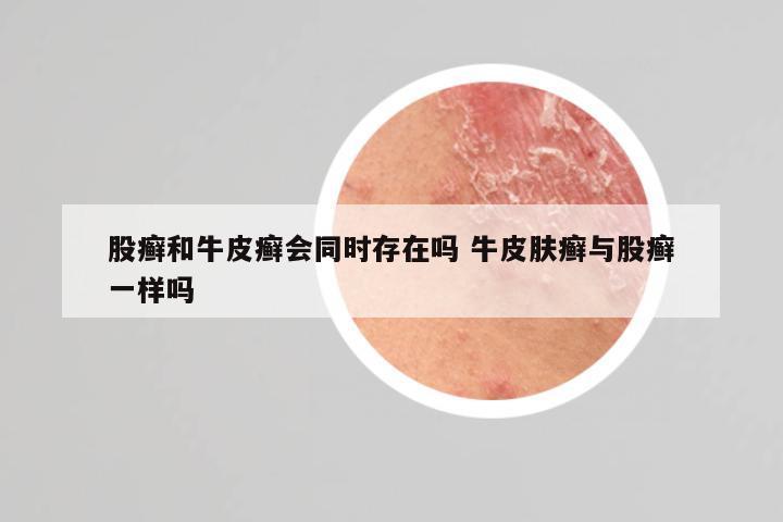 股癣和牛皮癣会同时存在吗 牛皮肤癣与股癣一样吗