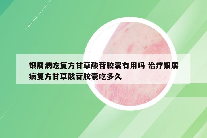 银屑病吃复方甘草酸苷胶囊有用吗 治疗银屑病复方甘草酸苷胶囊吃多久