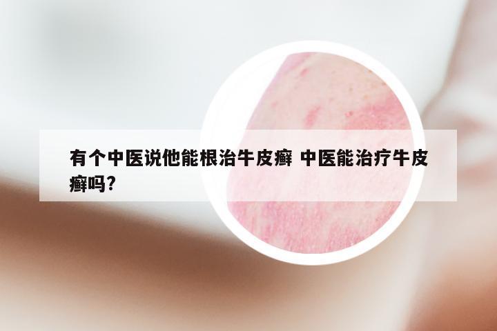 有个中医说他能根治牛皮癣 中医能治疗牛皮癣吗?