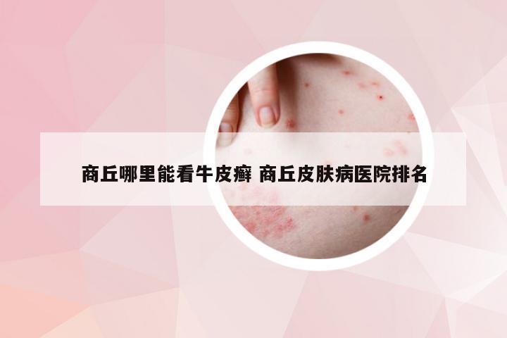 商丘哪里能看牛皮癣 商丘皮肤病医院排名