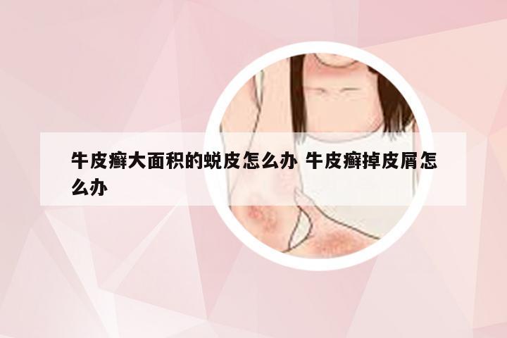 牛皮癣大面积的蜕皮怎么办 牛皮癣掉皮屑怎么办
