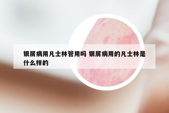 银屑病用凡士林管用吗 银屑病用的凡士林是什么样的