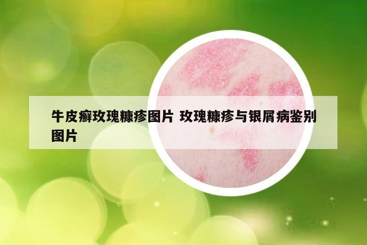 牛皮癣玫瑰糠疹图片 玫瑰糠疹与银屑病鉴别图片