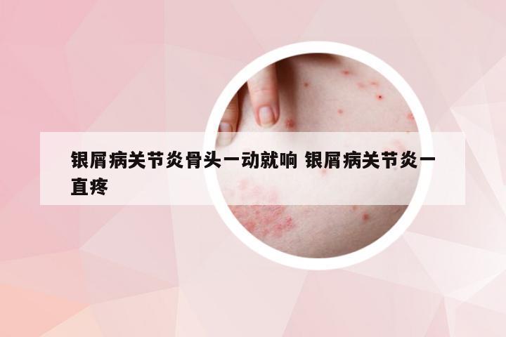 银屑病关节炎骨头一动就响 银屑病关节炎一直疼