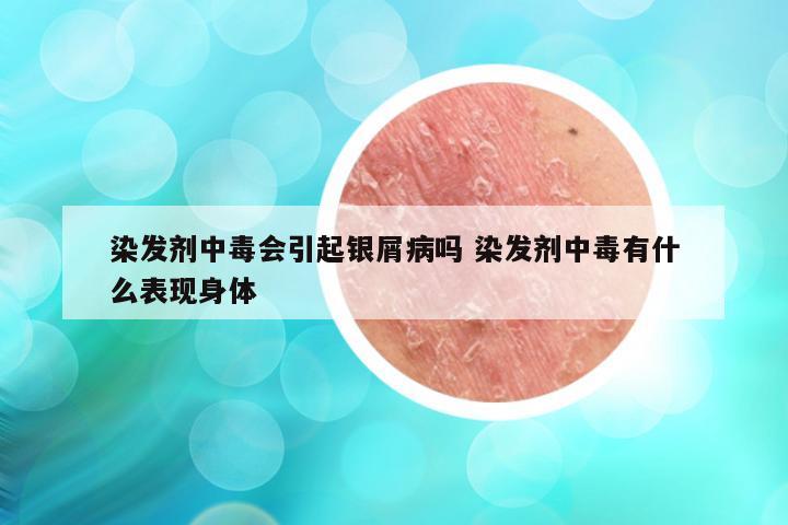 染发剂中毒会引起银屑病吗 染发剂中毒有什么表现身体