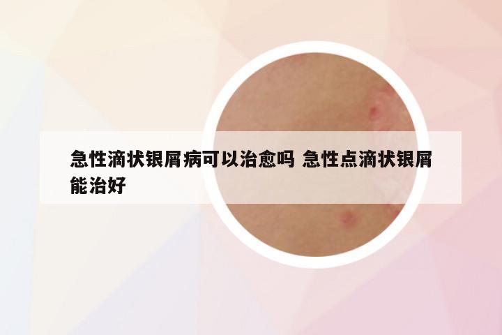 急性滴状银屑病可以治愈吗 急性点滴状银屑能治好
