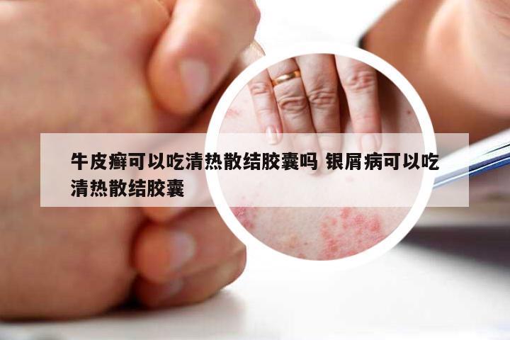 牛皮癣可以吃清热散结胶囊吗 银屑病可以吃清热散结胶囊