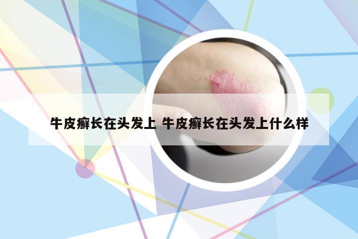 牛皮癣长在头发上 牛皮癣长在头发上什么样