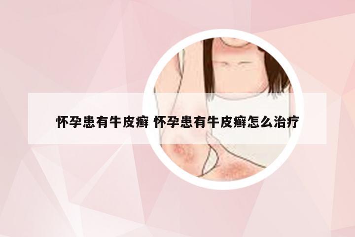 怀孕患有牛皮癣 怀孕患有牛皮癣怎么治疗