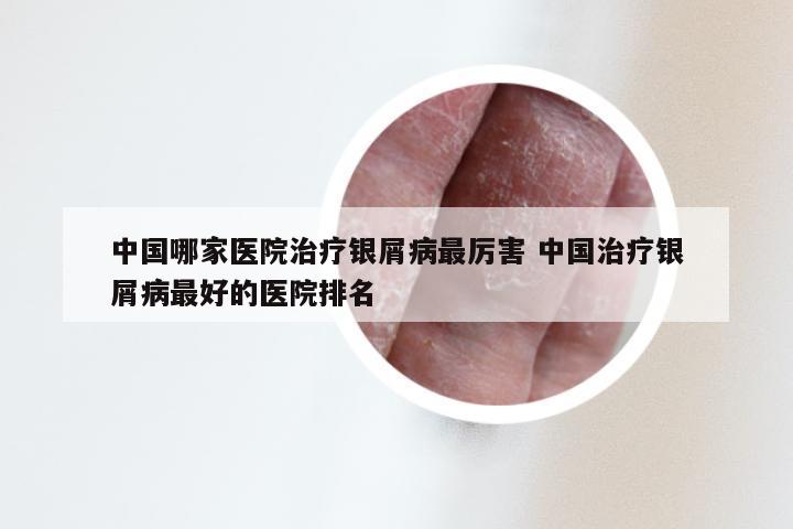 中国哪家医院治疗银屑病最厉害 中国治疗银屑病最好的医院排名