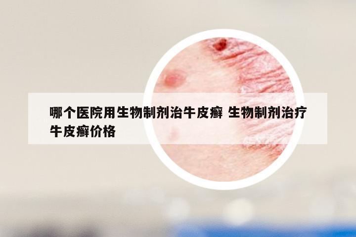 哪个医院用生物制剂治牛皮癣 生物制剂治疗牛皮癣价格
