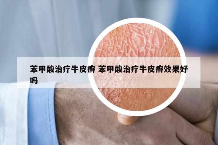 苯甲酸治疗牛皮癣 苯甲酸治疗牛皮癣效果好吗