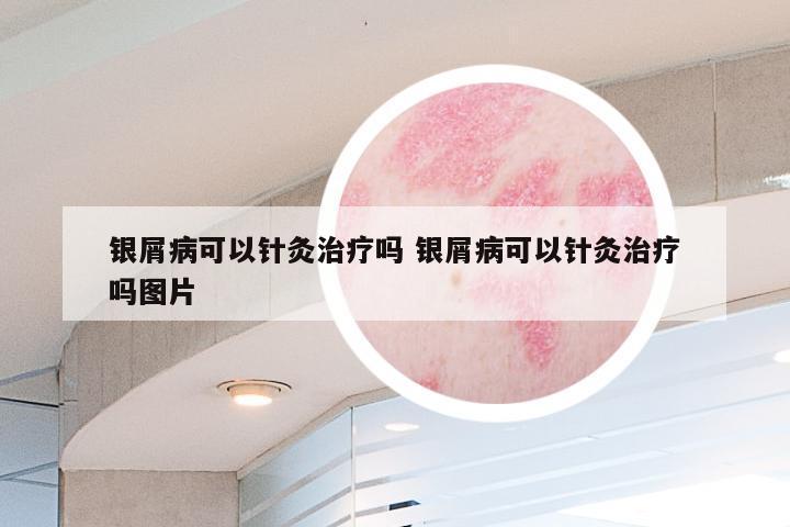 银屑病可以针灸治疗吗 银屑病可以针灸治疗吗图片